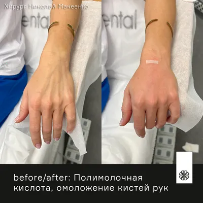 Биоревитализация рук | Косметология, Инъекции губ, Косметолог