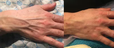 Биоревитализация(увлажнение) кожи рук гиалуроновой кислотой в  Санкт-Петербурге — БИОМЕД