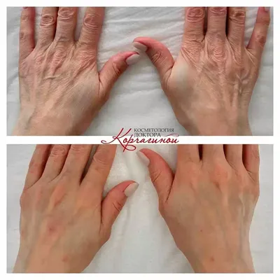 Омоложение кожи рук в Москве цена, отзывы, фото - Косметология доктора  Корчагиной