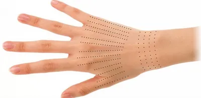 Биоревитализация кистей рук - все о процедуре, эффект | Evolution