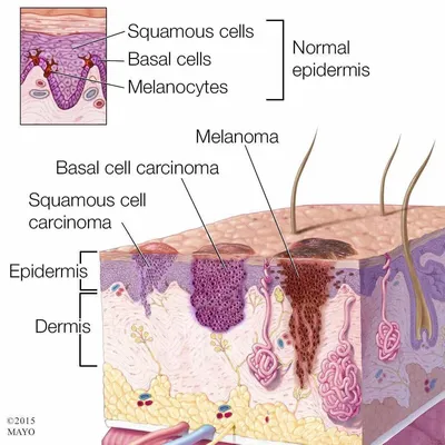 Меланома кожи: как выглядит, симптомы, причины, диагностика, лечение