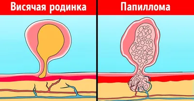 Родинки с неровными краями – опасны ли они