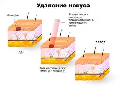 Как отличить опасные родинки от остальных?