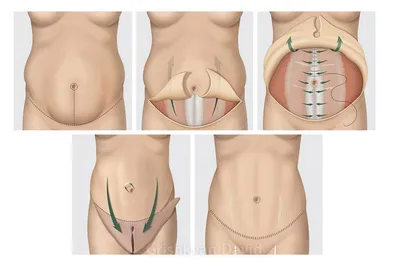 Абдоминопластика — Пластический хирург Михайлов Андрей Анатольевич