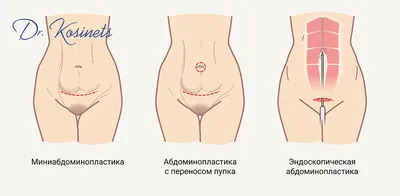 Операция на пупочной грыже — Лечение грыжи живота, операция, удаление грыжи  в Киеве - Хирург Рейзин Денис