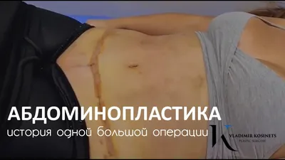 Подтяжка живота в Днепре — клиника Daily Medical