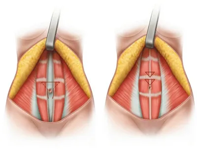 Абдоминопластика живота - Цена в Москве | Пластика живота
