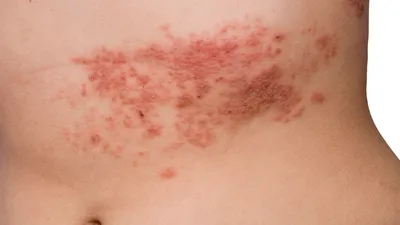 Опоясывающий лишай (опоясывающий герпес, herpes zoster): симптомы и  профилактика