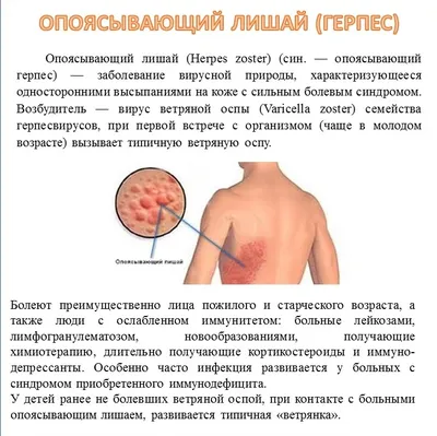 Благовещенск | Опоясывающий лишай (герпес) - БезФормата
