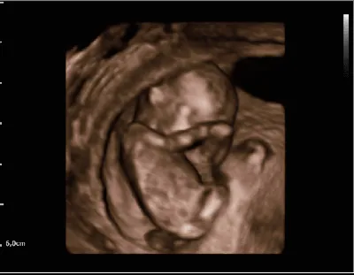 Пол малыша в 13 недель по Узи. Кто разбирается в снимках?) - Вопросы о  беременности - BabyPlan