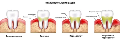 Прорезывание зубов у детей: симптомы и осложнения