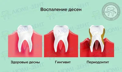 Шатается коренной зуб, болит зуб, гноится десна? Скрипите во сне зубами?  Основные симптомы стоматологических заболеваний