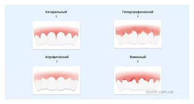 Укрепление десен - Статьи