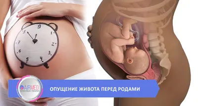 Опущение живота перед родами | 🤰🏻 👶🏻 🥳 Профільна лікарня AIRMED