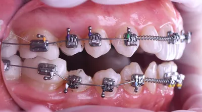 Ортодонтия | КамилДент