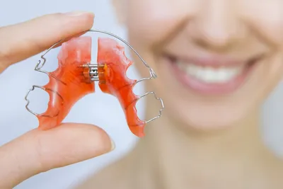 Характеристики и преимущества лингвальной ортодонтии | Clínica Dental  Moreno-Montalvo