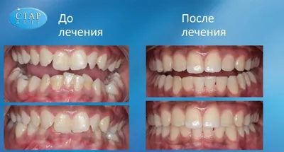 Ортодонтическое лечение - Стоматология Харьков «Стар-Дент»