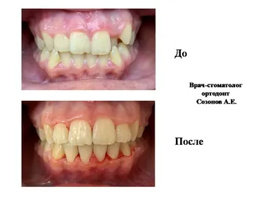 Ортодонтия с брекетами – ортодонт – зубные брекеты