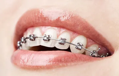 Ортодонтия в стоматологии – Семейная клиника «Доктор АННА»