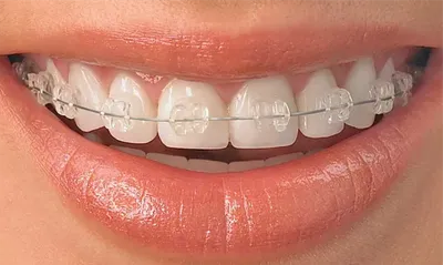 Ортодонтия. Работаю быстро и качественно. (91305) - Зуботехнические  лаборатории - NaviStom.com