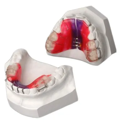 Ровно один месяц накладки были , сегодня снял ))) , #orthodontia #dental  #dentist #брекеты#inprogress #брекетытверь #ортодонт #ортодонтия… |  Instagram