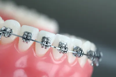 Ортодонтия - Аванстом, стоматологическая клиника