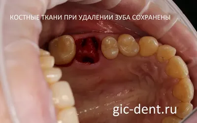 После удаления зуба остался кусочек, осколок в десне — что делать, если  вырвали зуб без корня