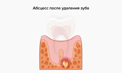 Осколок зуба после удаления: какие симптомы и последствия, удаление осколка