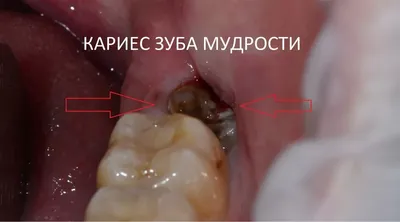 Удаление зуба. Осложнение - Центр ортодонтии №1