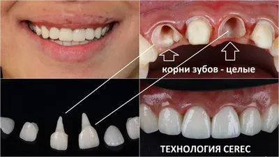 Атравматичное удаление зубов мудрости. Правила и рекомендации.