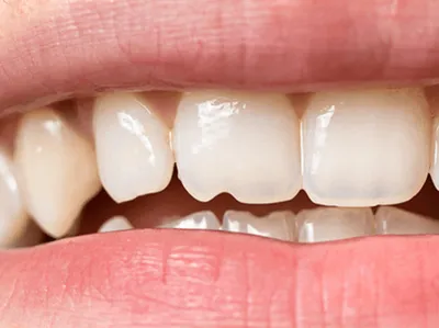 Гноится десна после удаления зуба — 4 причины, 5 симптомов и лечение |  Dental Art