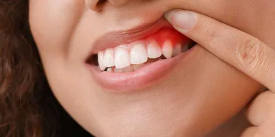 Что такое альвеолит зуба и как его лечить? | Silkdentist
