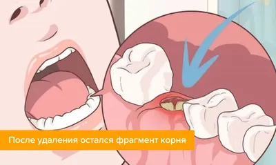 Остался осколок зуба после удаления: что делать, если в десне остался  корень?