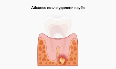 Как восстановить зуб если остался только один корень | Альянс  бьюти-ортопедов, Москва
