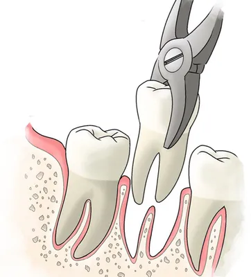 Удаление корня зуба в Уфе | Стоматологическая клиника «Маэстро»