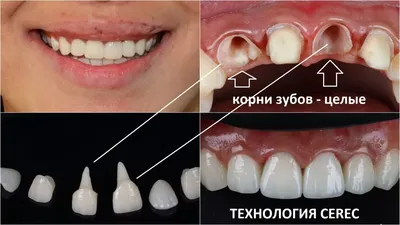 Процесс восстановления переднего зуба разрушенного супер клеем