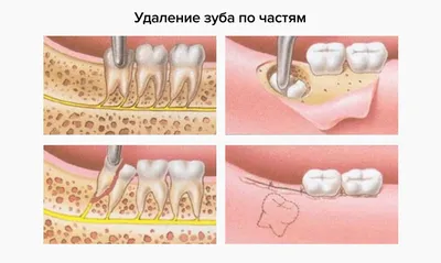 Остался осколок зуба после удаления: что делать, если в десне остался  корень?