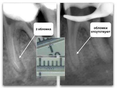 Шишка на десне после удаления зуба - Стоматология Северное Бутово Делия  только качественные услуги