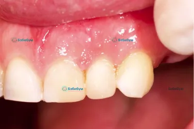 Абсцесс зуба - что это такое, причины, симптомы, диагностика, лечение  (удаление, вскрытие)