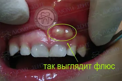 Сломанный инструмент в зубном канале после лечения...?