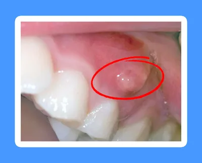 Раскол зуба и одномоментная имплантация