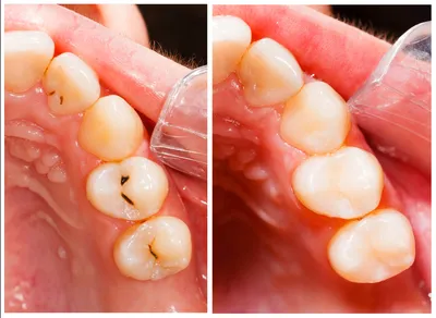 Стоматологическая клиника \"HomeDent\" - Что делать, если после удаления зуба  в лунке остался осколок⁉ ⠀ ✓Во-первых, не стоит ставить себе такой диагноз  самостоятельно. ⠀ Нередко за осколок зуба люди принимают острый край
