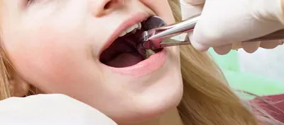 Осколок зуба после удаления: какие симптомы и последствия, удаление осколка