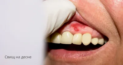 Восстановление переднего зуба без имплантации по технологии Cerec