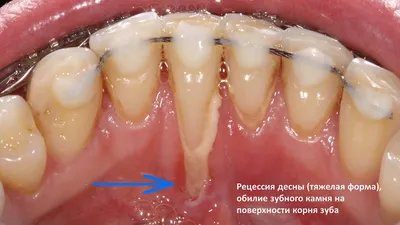 Удаление ретинированного зуба мудрости ультразвуком Piezosurgery
