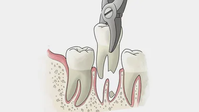 После удаления зуба остался кусочек, осколок в десне — что делать, если  вырвали зуб без корня