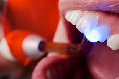 Что делать, если десна отошла от зуба? - Стоматология Северное Бутово Делия  только качественные услуги