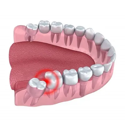 Удаление зубов в Подольске. Стоматология Улыбка | Стоматология Улыбка