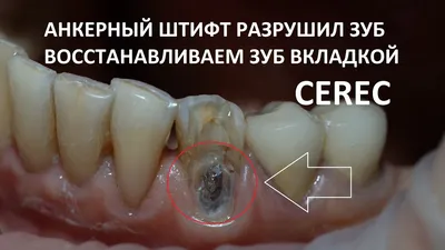 Кусок сверла остался в десне жительницы Новосибирска после удаления зуба |  НДН.Инфо