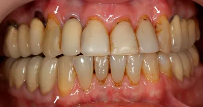 Почему на зубе опустилась десна, что делать – стоматология ПрезиДЕНТ